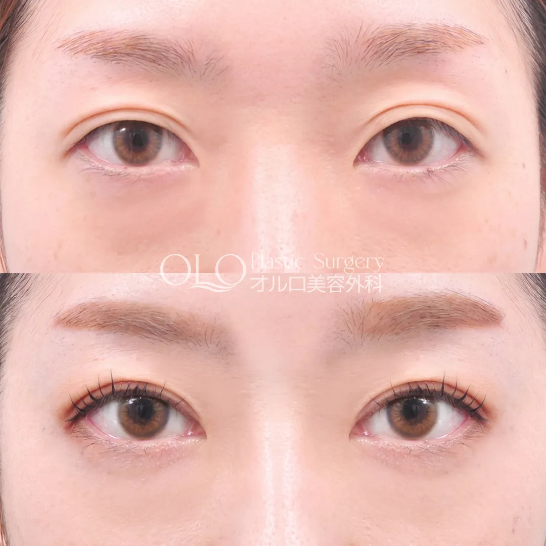 自然二重埋没(再手術)+上眼瞼切開(目を大きく見せる上側の切開) の症例写真(Before / After)